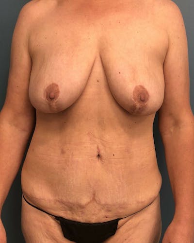 Mommy Makeover Before & After Gallery - Patient 228450 - Image 1