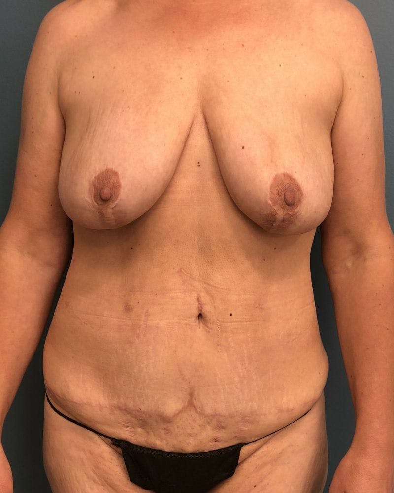 Mommy Makeover Before & After Gallery - Patient 228450 - Image 1