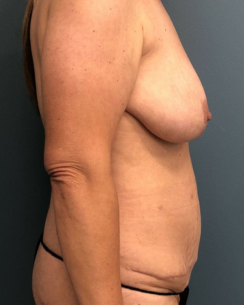 Mommy Makeover Before & After Gallery - Patient 228450 - Image 3