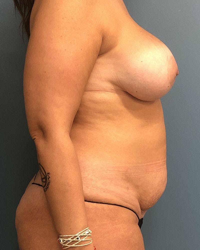 Mommy Makeover Before & After Gallery - Patient 823149 - Image 3