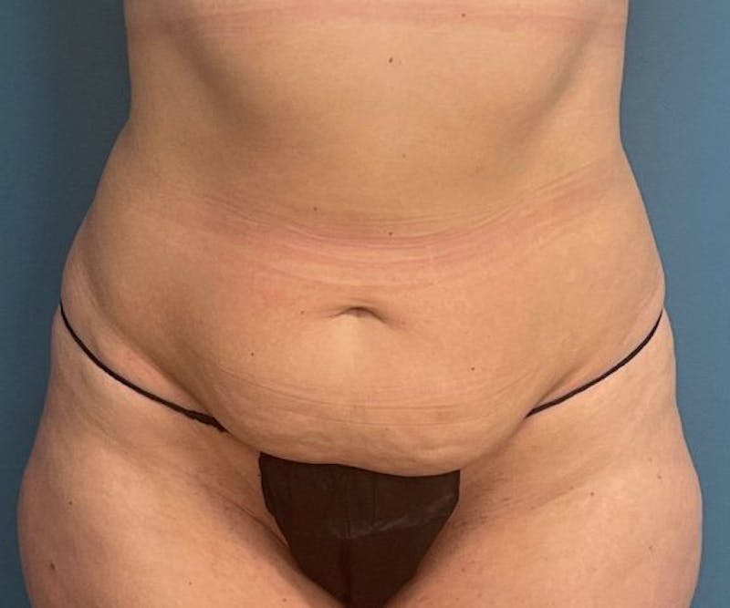 Powertuck Before & After Gallery - Patient 363094 - Image 1