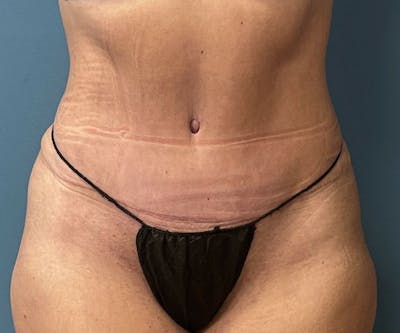 Powertuck Before & After Gallery - Patient 363094 - Image 2