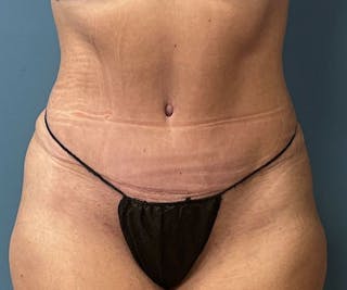 Powertuck Before & After Gallery - Patient 363094 - Image 2