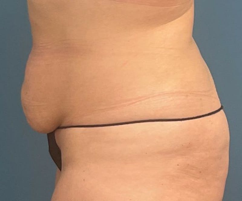 Powertuck Before & After Gallery - Patient 363094 - Image 3