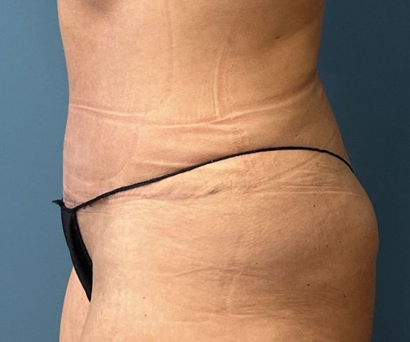Powertuck Before & After Gallery - Patient 363094 - Image 4