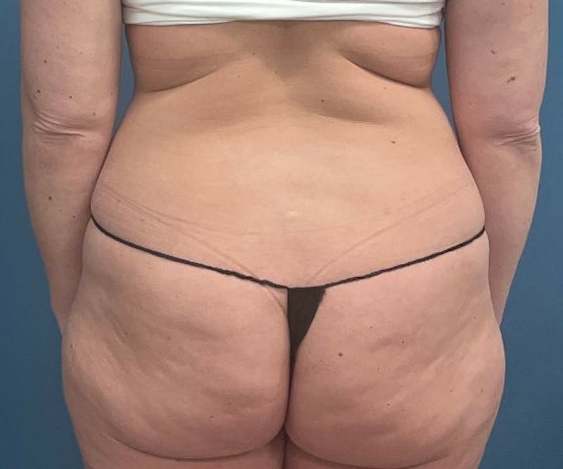 Powertuck Before & After Gallery - Patient 363094 - Image 5