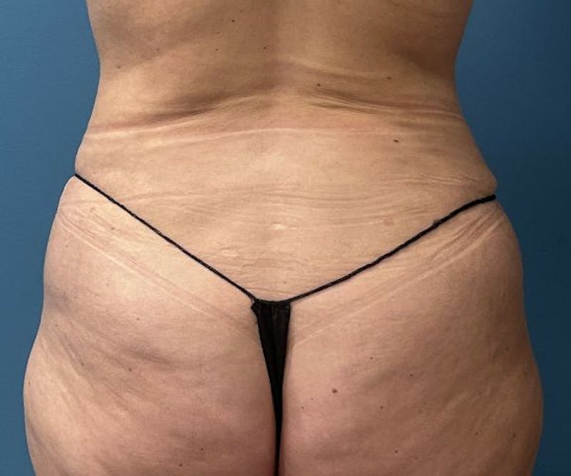 Powertuck Before & After Gallery - Patient 363094 - Image 6