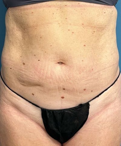 Powertuck Before & After Gallery - Patient 267158 - Image 1