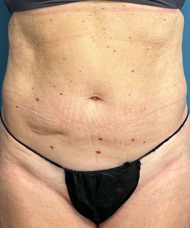 Powertuck Before & After Gallery - Patient 267158 - Image 1