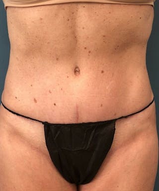 Powertuck Before & After Gallery - Patient 267158 - Image 2