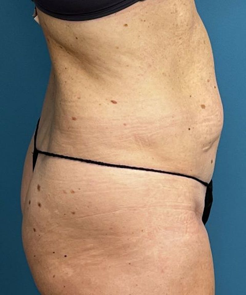 Powertuck Before & After Gallery - Patient 267158 - Image 3