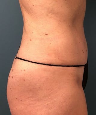 Powertuck Before & After Gallery - Patient 267158 - Image 4