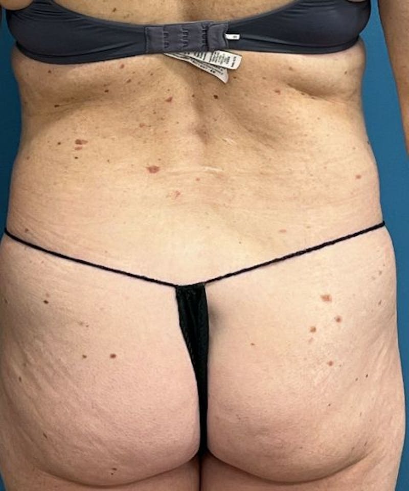 Powertuck Before & After Gallery - Patient 267158 - Image 5