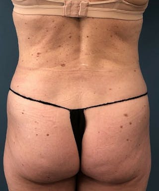 Powertuck Before & After Gallery - Patient 267158 - Image 6