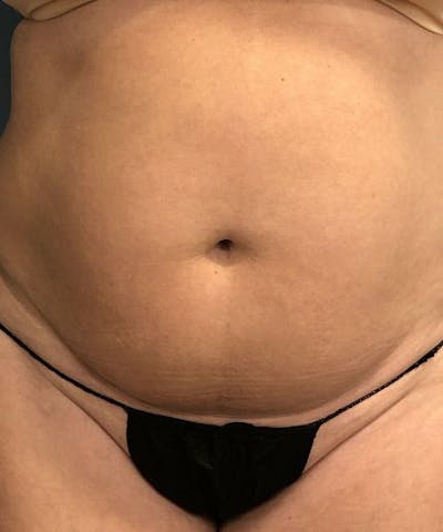 Powertuck Before & After Gallery - Patient 234391 - Image 1