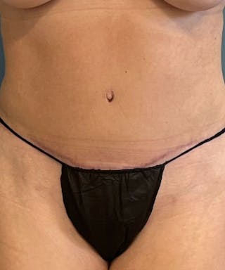 Powertuck Before & After Gallery - Patient 234391 - Image 2