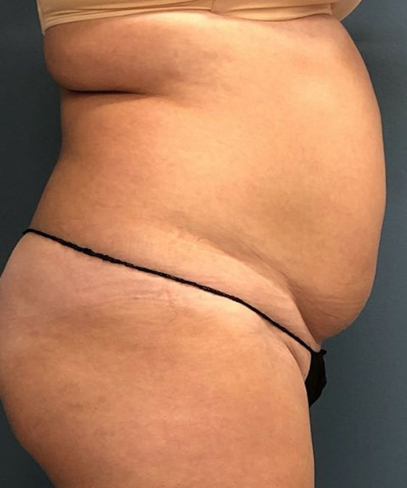 Powertuck Before & After Gallery - Patient 234391 - Image 3