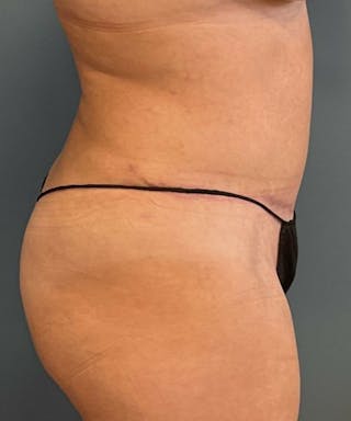 Powertuck Before & After Gallery - Patient 234391 - Image 4