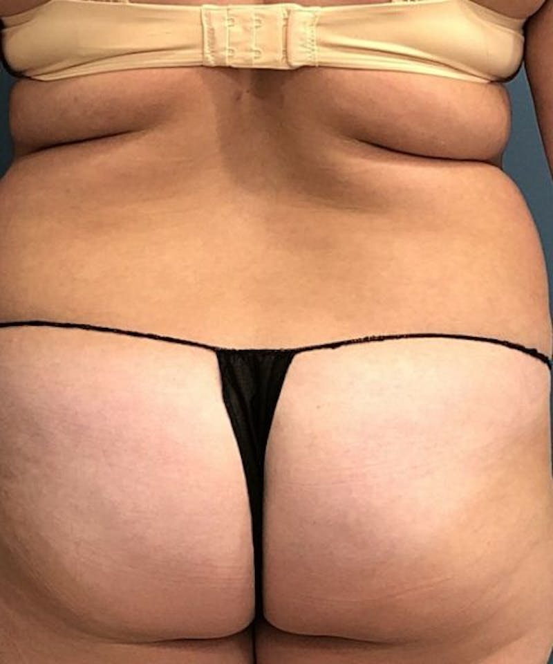 Powertuck Before & After Gallery - Patient 234391 - Image 5