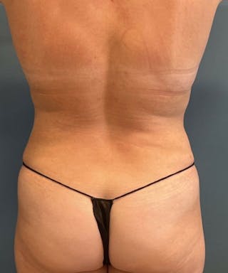 Powertuck Before & After Gallery - Patient 234391 - Image 6