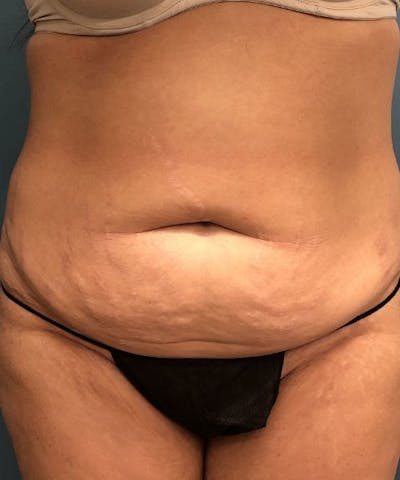 Powertuck Before & After Gallery - Patient 372088 - Image 1