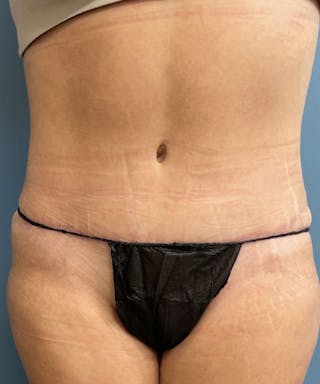 Powertuck Before & After Gallery - Patient 372088 - Image 2