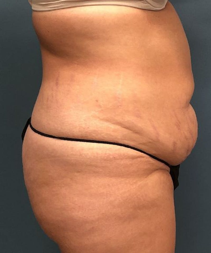 Powertuck Before & After Gallery - Patient 372088 - Image 3