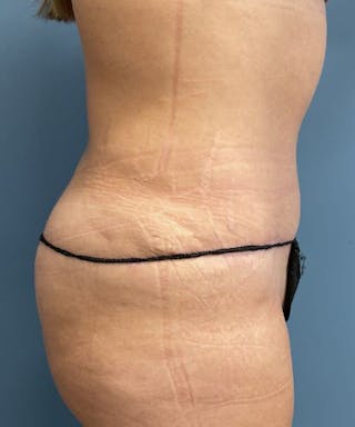 Powertuck Before & After Gallery - Patient 372088 - Image 4