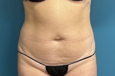 Powertuck Before & After Gallery - Patient 118244 - Image 1