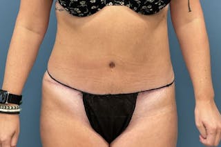 Powertuck Before & After Gallery - Patient 118244 - Image 2