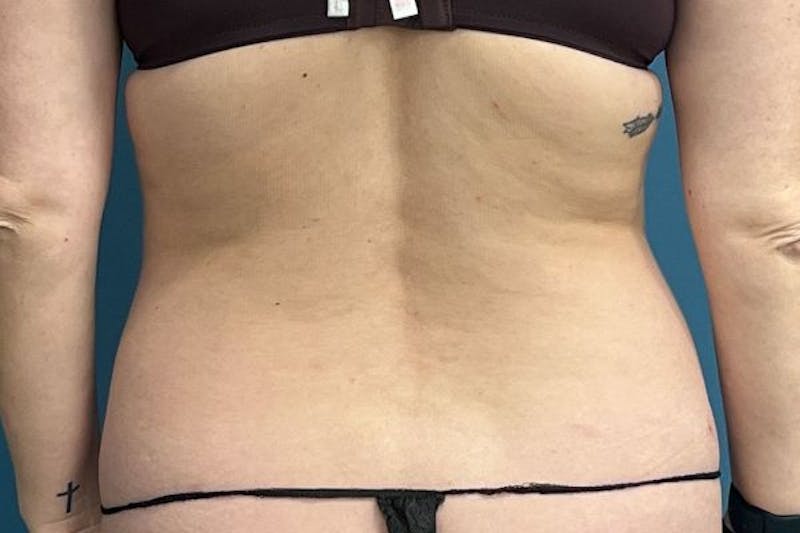 Powertuck Before & After Gallery - Patient 118244 - Image 3