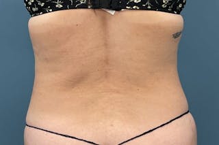 Powertuck Before & After Gallery - Patient 118244 - Image 4