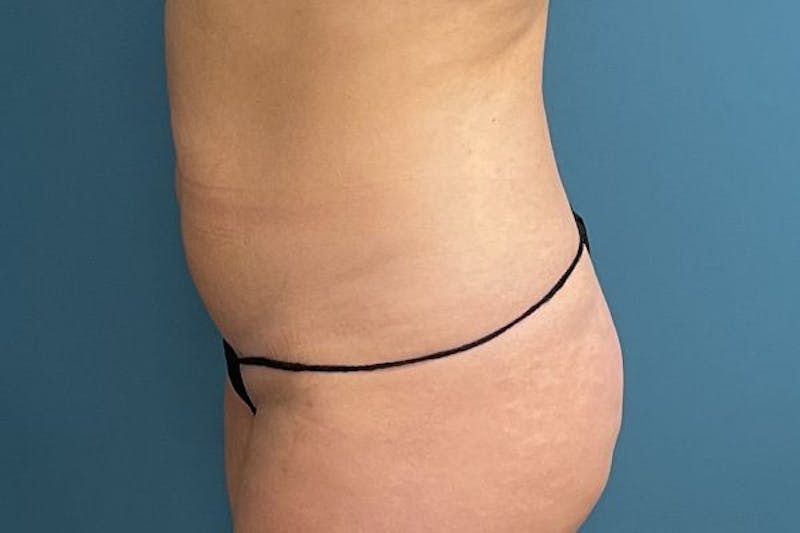 Powertuck Before & After Gallery - Patient 118244 - Image 5