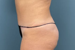 Powertuck Before & After Gallery - Patient 118244 - Image 6