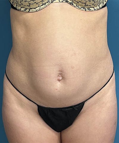 Powertuck Before & After Gallery - Patient 183233 - Image 1