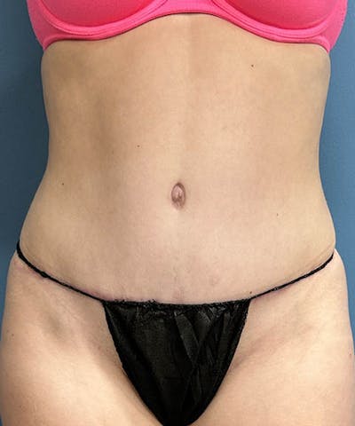 Powertuck Before & After Gallery - Patient 183233 - Image 2