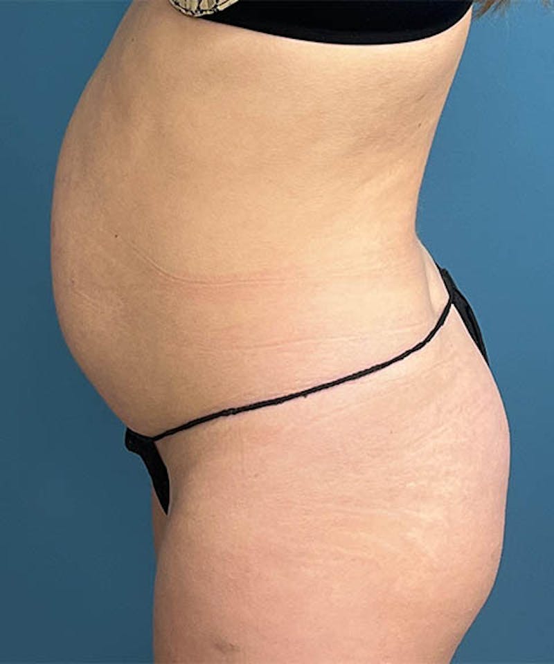 Powertuck Before & After Gallery - Patient 183233 - Image 3