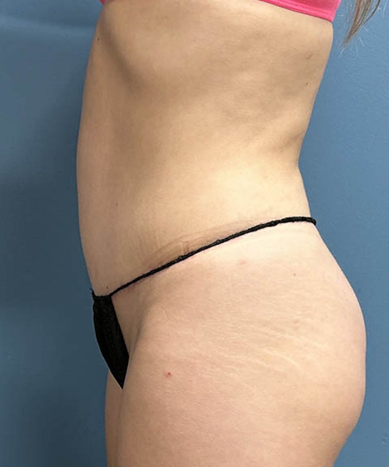 Powertuck Before & After Gallery - Patient 183233 - Image 4