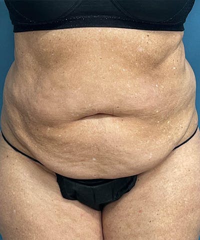 Powertuck Before & After Gallery - Patient 250085 - Image 1