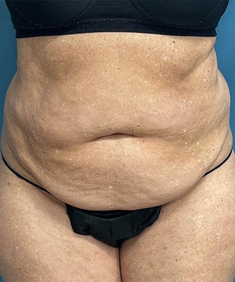 Powertuck Before & After Gallery - Patient 250085 - Image 1