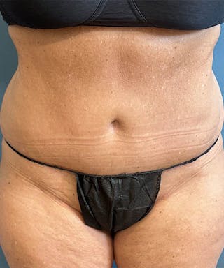 Powertuck Before & After Gallery - Patient 250085 - Image 2