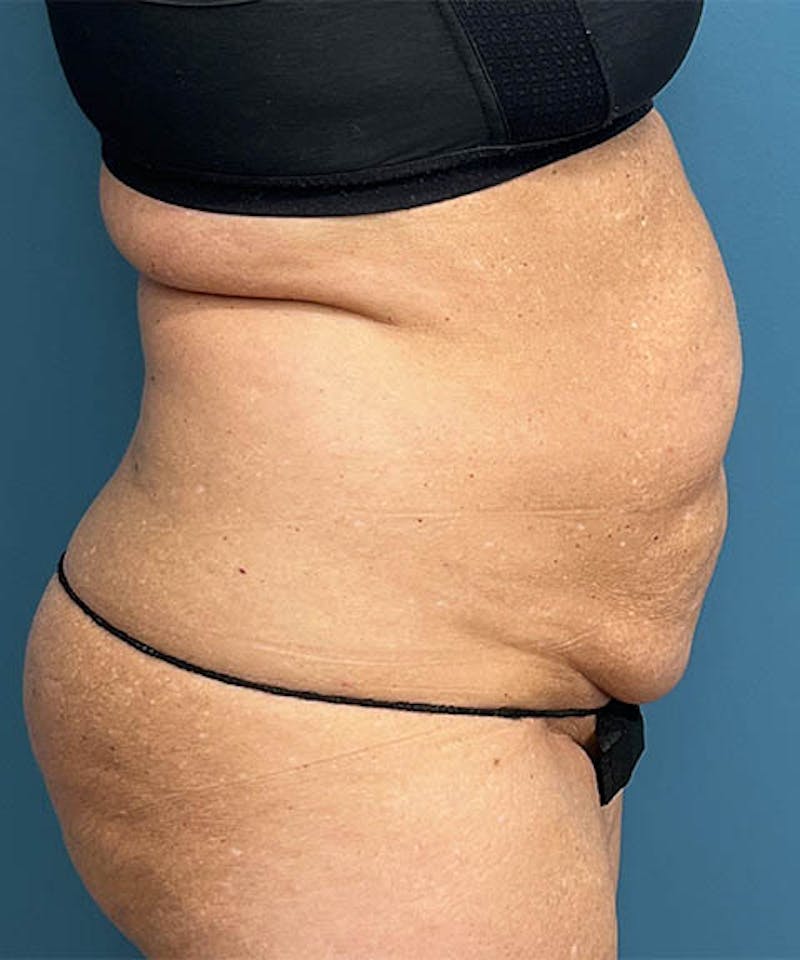 Powertuck Before & After Gallery - Patient 250085 - Image 3