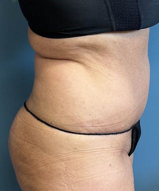 Powertuck Before & After Gallery - Patient 250085 - Image 4
