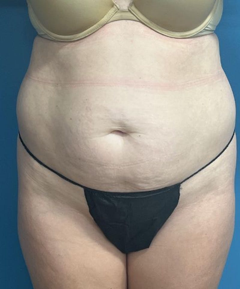 Powertuck Before & After Gallery - Patient 231725 - Image 1