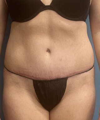 Powertuck Before & After Gallery - Patient 231725 - Image 2