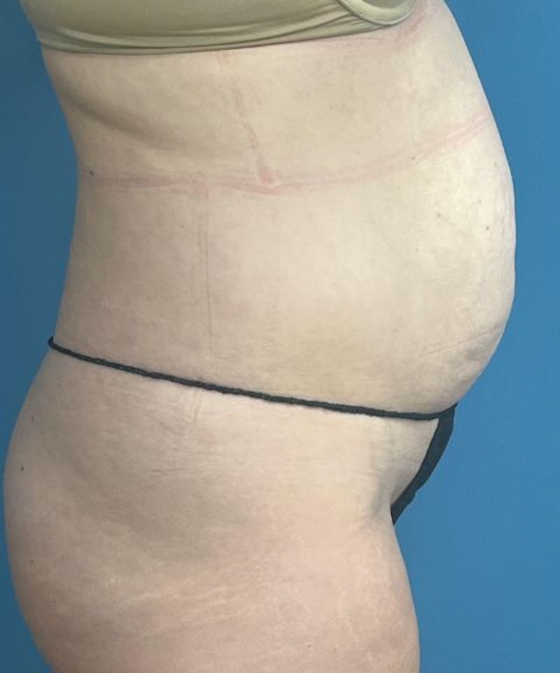 Powertuck Before & After Gallery - Patient 231725 - Image 3