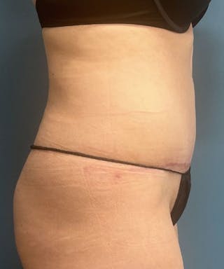 Powertuck Before & After Gallery - Patient 231725 - Image 4