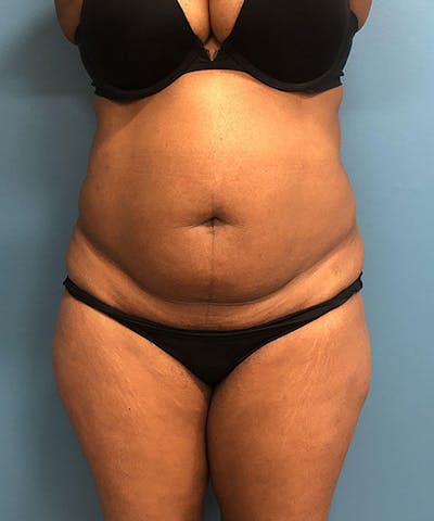 Powertuck Before & After Gallery - Patient 372566 - Image 1