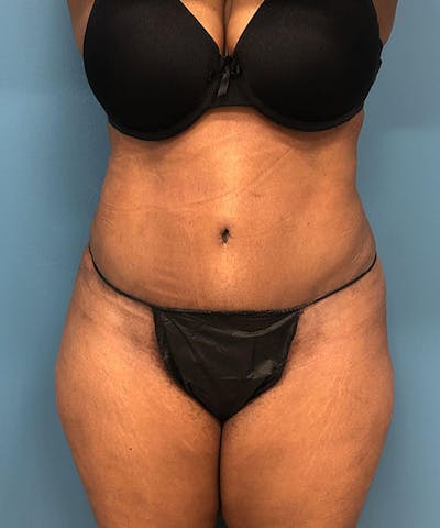 Powertuck Before & After Gallery - Patient 372566 - Image 2
