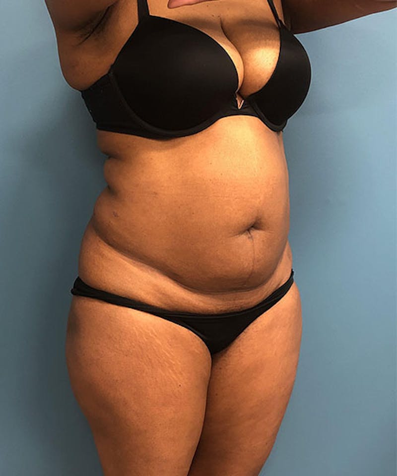 Powertuck Before & After Gallery - Patient 372566 - Image 3